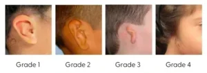 Microtia y Atresia: Respuestas a las preguntas más frecuentes