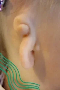 Microtia y Atresia: Respuestas a las preguntas más frecuentes
