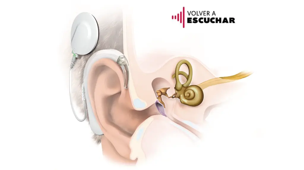 Implante auditivo y localización del sonido: ¿cómo se relacionan?
