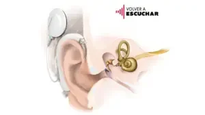 Lee más sobre el artículo Implante auditivo y localización del sonido: ¿cómo se relacionan?