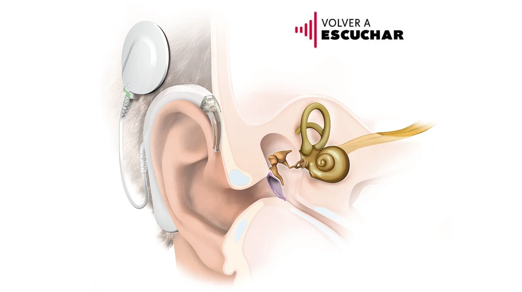 En este momento estás viendo Implante auditivo y localización del sonido: ¿cómo se relacionan?
